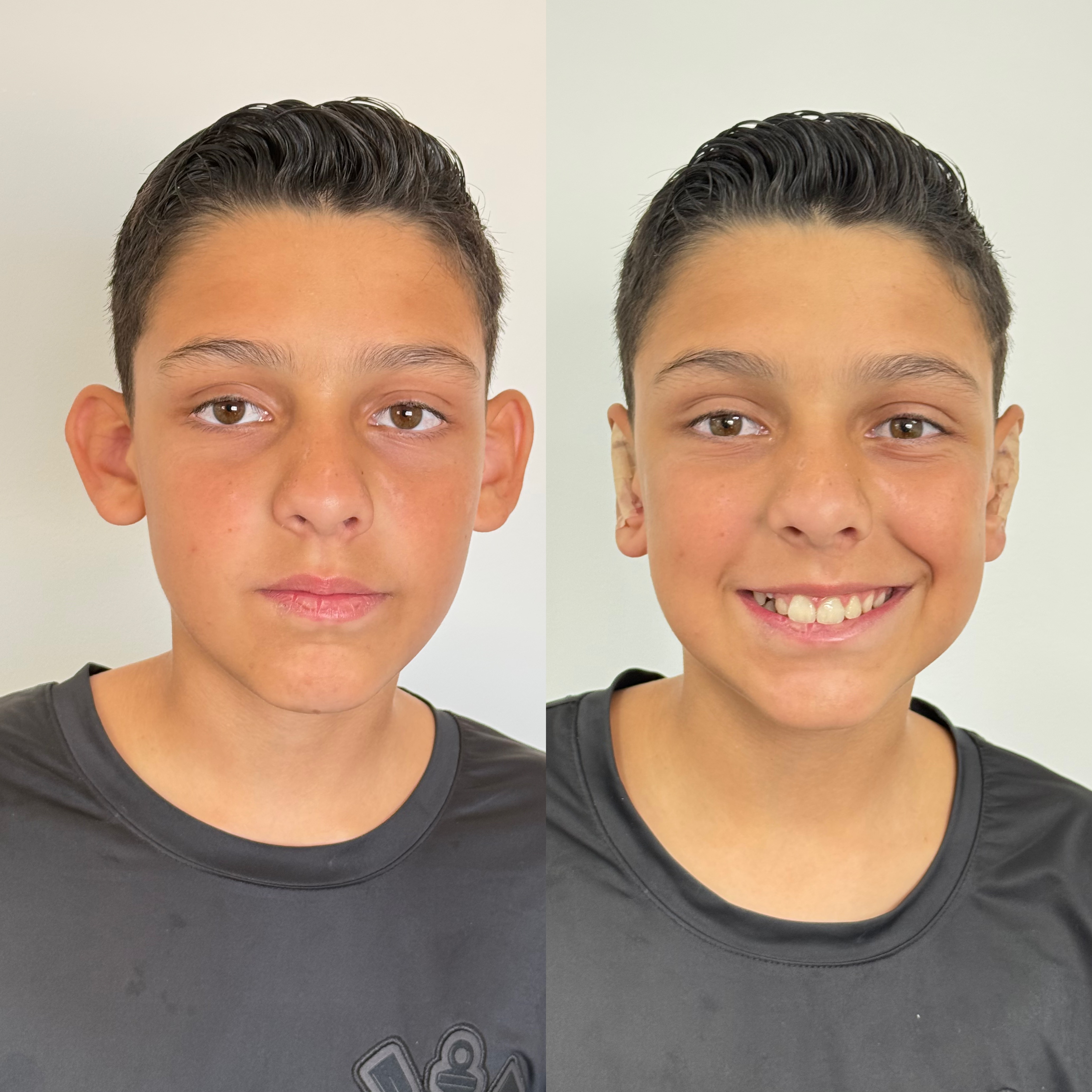 Comparativo autorizado de otomodelação, antes e depois, caso 3