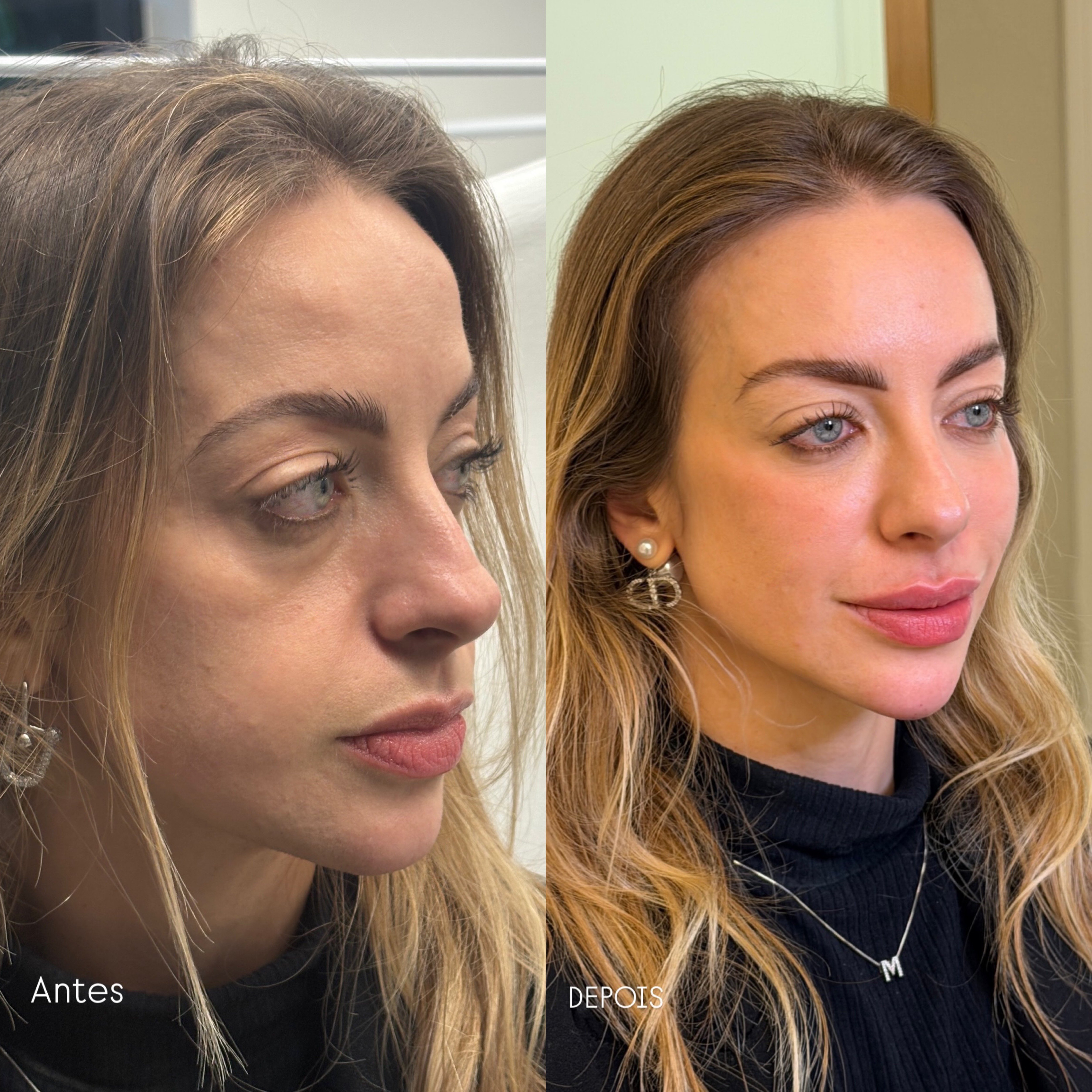 Comparativo autorizado de harmonização facial, antes e depois, apresentado lado a lado