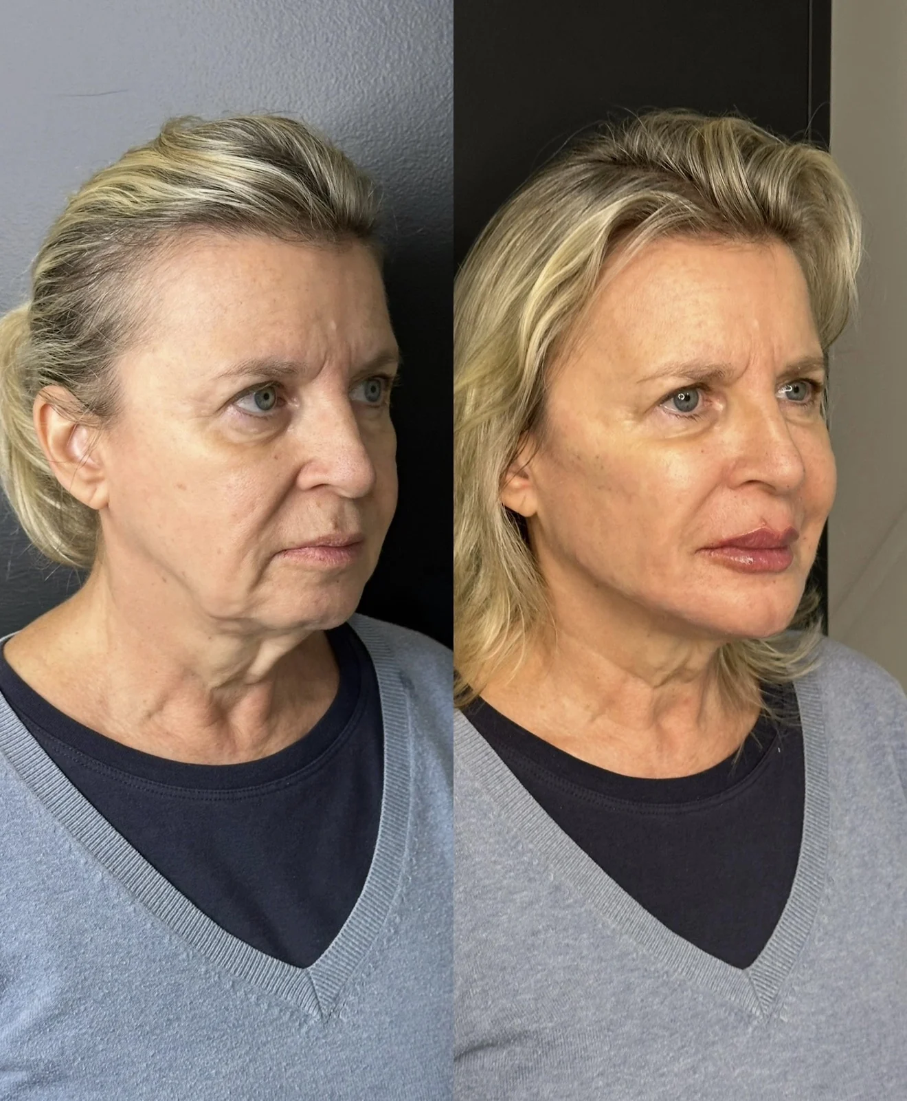 Segundo comparativo autorizado de rejuvenescimento facial, antes e depois, apresentado lado a lado