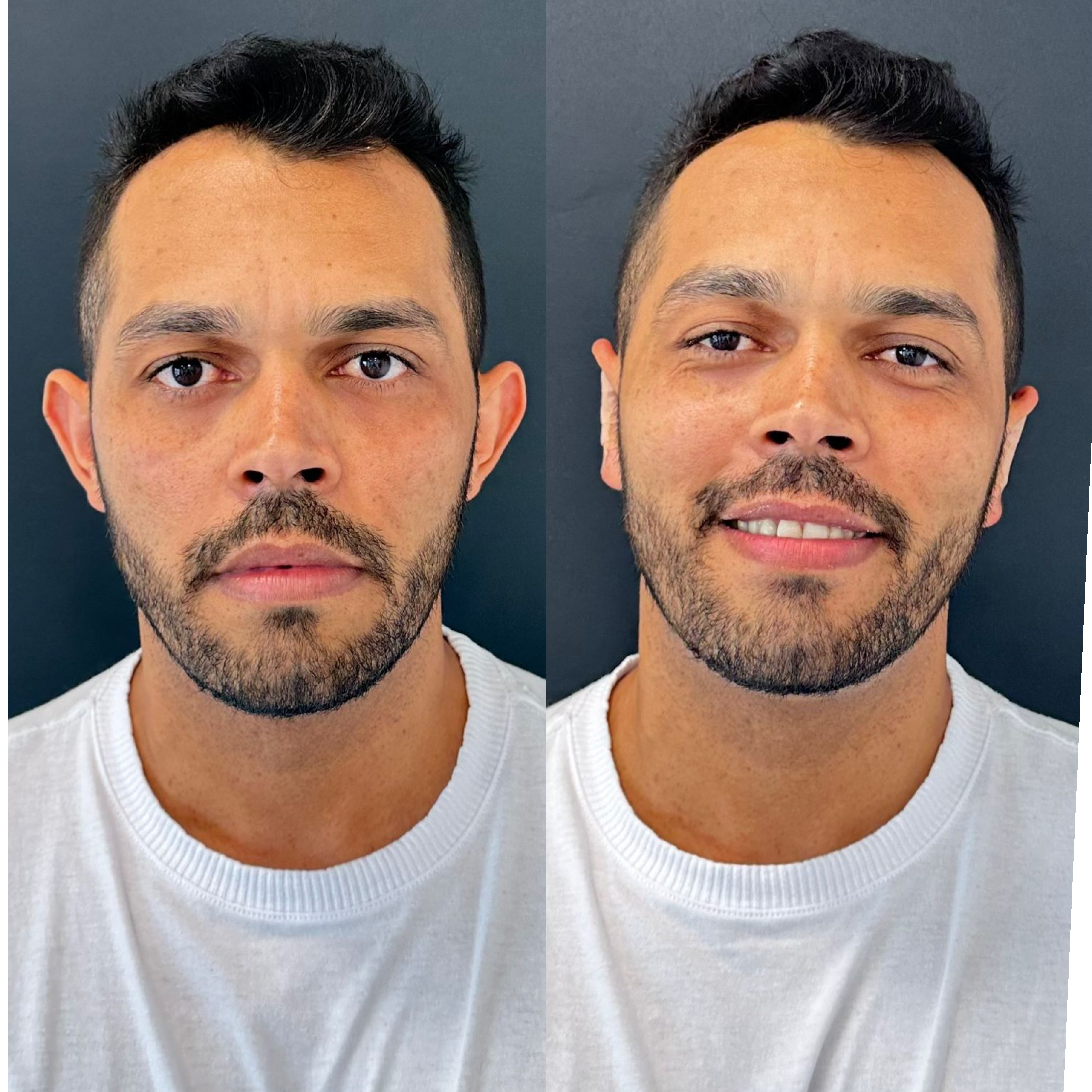 Comparativo autorizado de otomodelação, antes e depois, caso 1