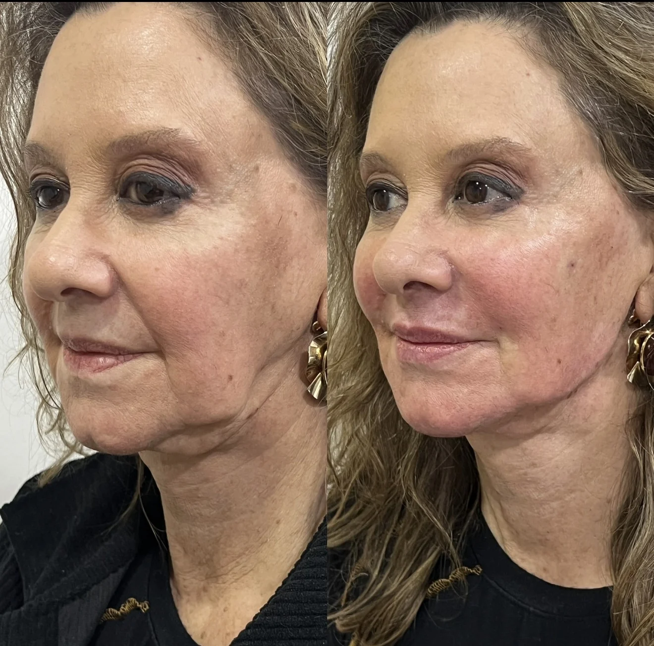 Comparativo autorizado de rejuvenescimento facial, antes e depois, apresentado lado a lado
