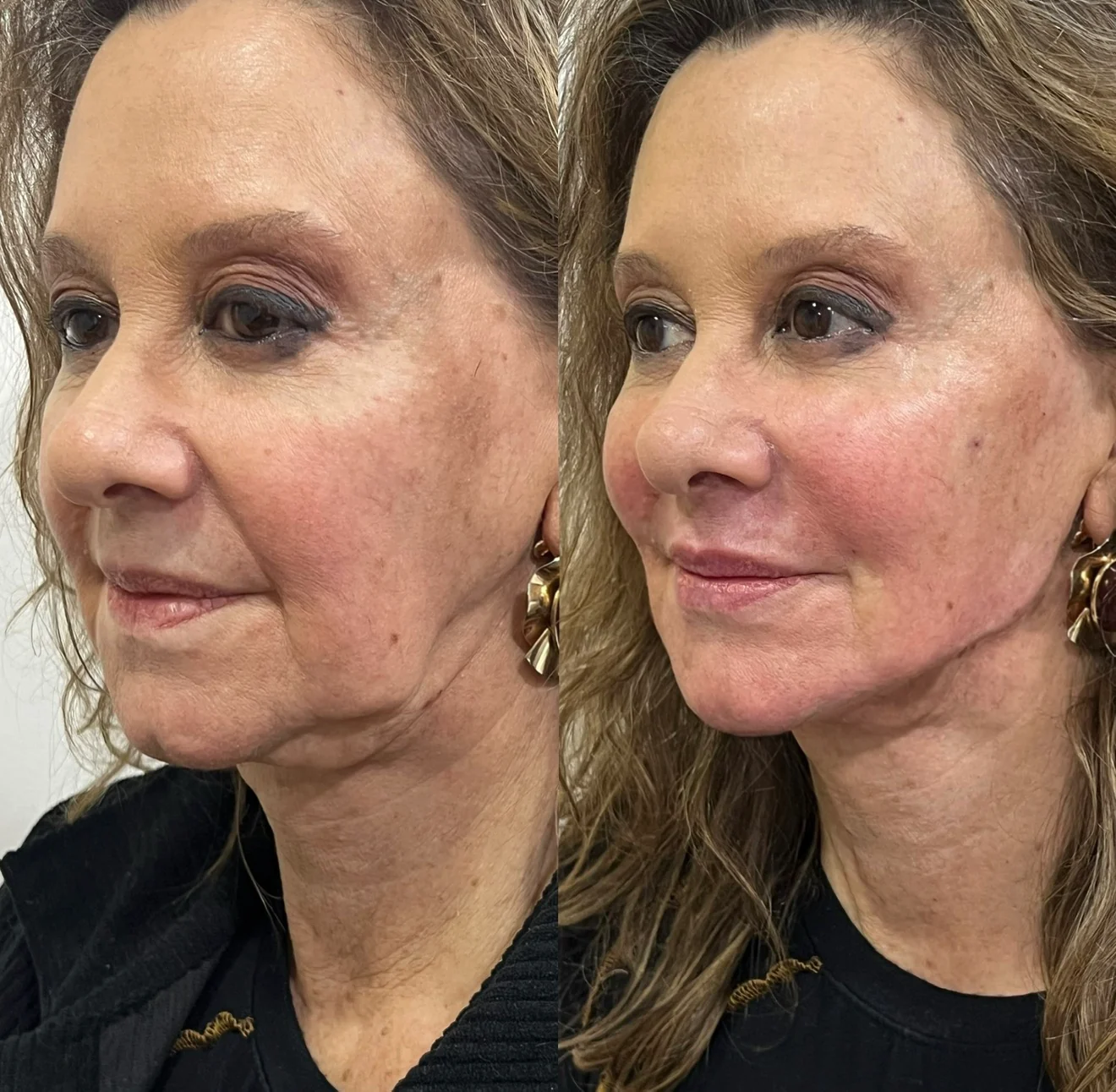 Segundo comparativo autorizado de harmonização facial, antes e depois, apresentado lado a lado