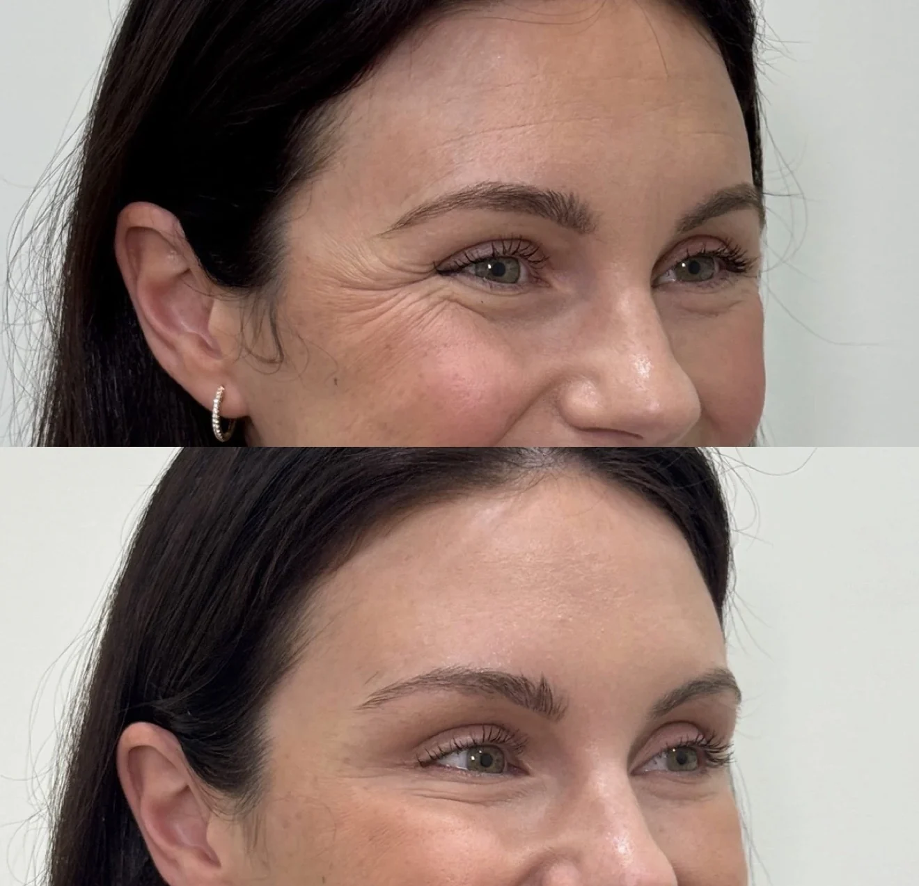 Comparativo autorizado de harmonização facial, antes e depois, apresentado lado a lado