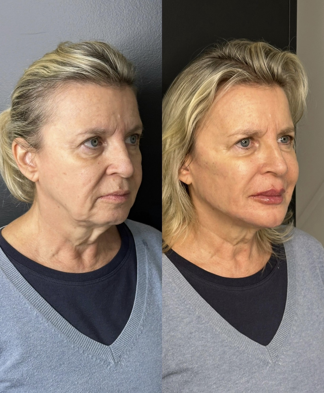 Comparativo autorizado de rejuvenescimento facial, antes e depois, apresentado lado a lado