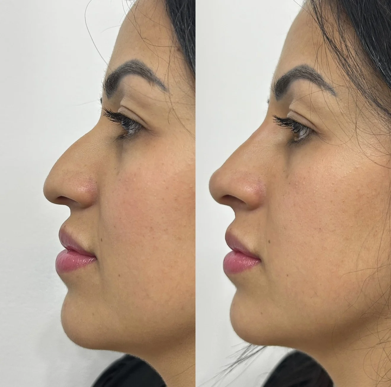 Segundo comparativo autorizado do perfil facial, antes e depois, apresentado lado a lado
